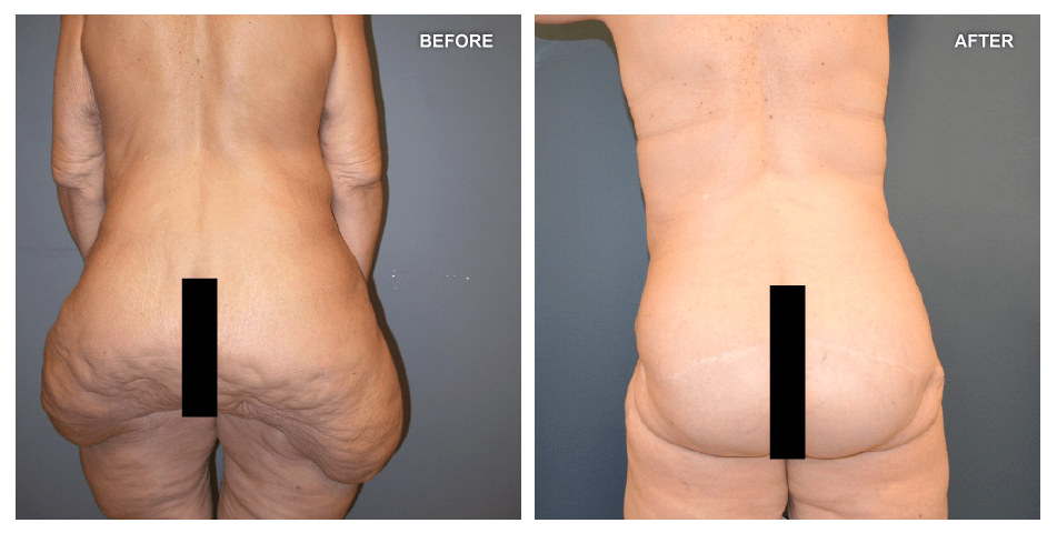 Lower Body Lift  Sound Plastic Surgery, Cosmetic Plastic Surgery Clinic  Seattle